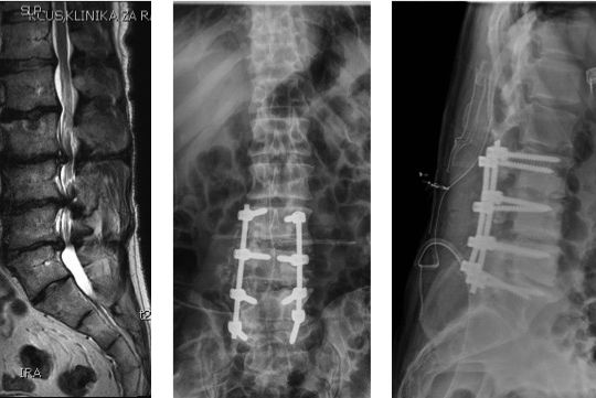 Posterior spinal fusion