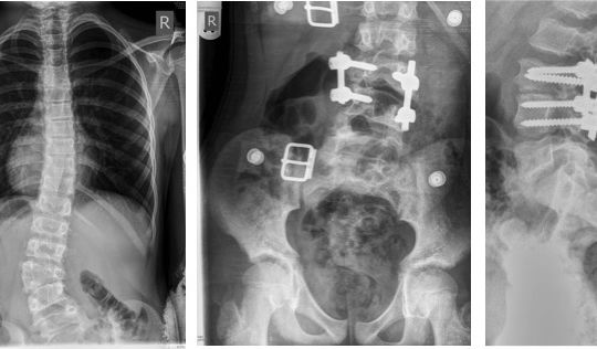 Surgical resection of the lumbar hemivertebra