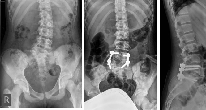 Implants donated