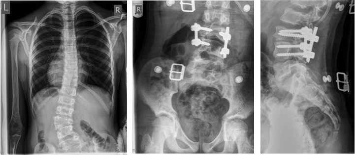 Surgical resection of the lumbar hemivertebra